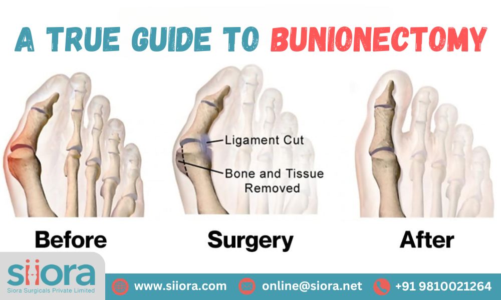 A True Guide to&nbsp;Bunionectomy