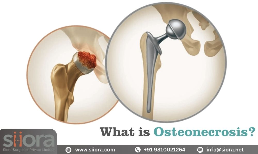 What is Osteonecrosis?