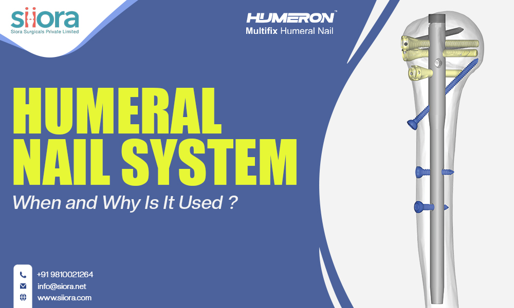 Humeral Nail System: When and Why Is It Used?