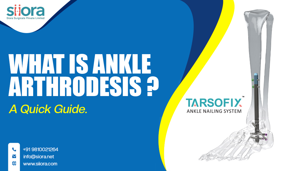 What is Ankle Arthrodesis? A Quick&nbsp;Guide.